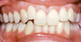 Braces - Orthodontics